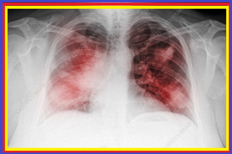 Atypical Pneumonia